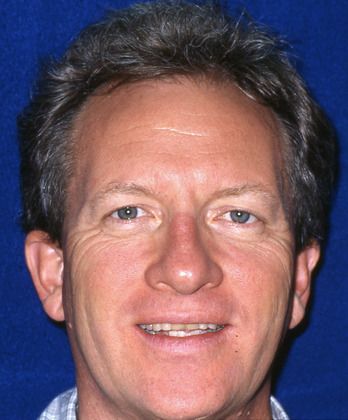 Before full mouth reconstruction